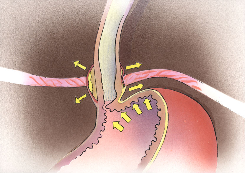 Anti Reflü Mekanizma