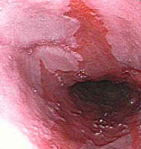 Yemek Borusu Barrett Hastalığı