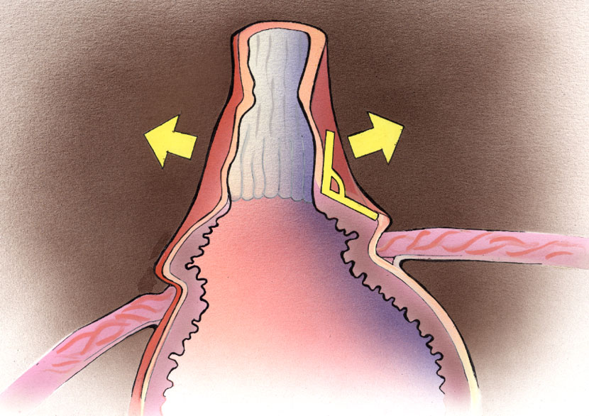 Bozulmuş His Açısı