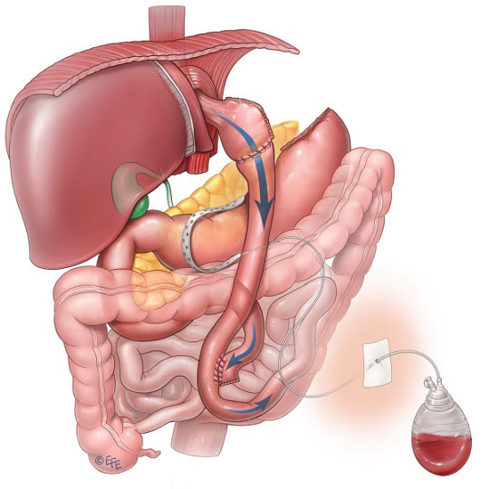 Gastrik bypass ameliyatı anatomik görünümü.