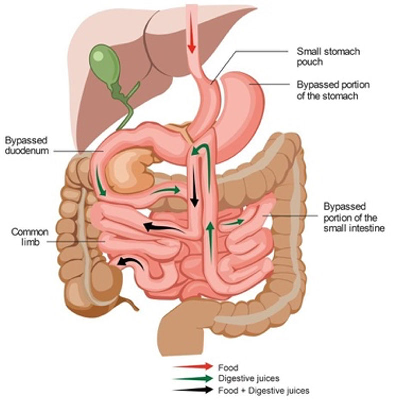 Mini Gastrik bypass ameliyatı anatomik görünümü.