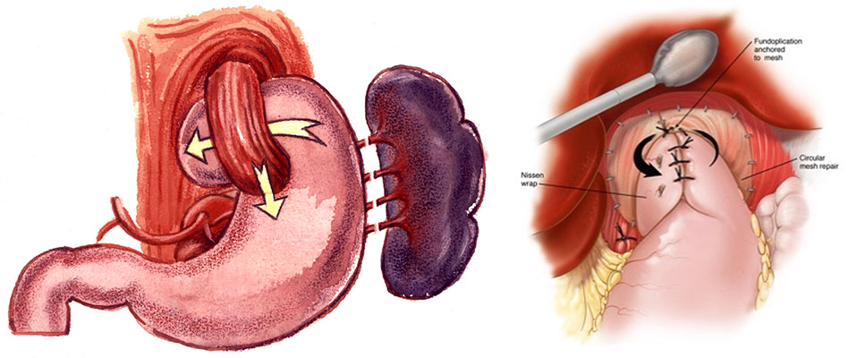 Reflü Ameliyatı Anatomisi
