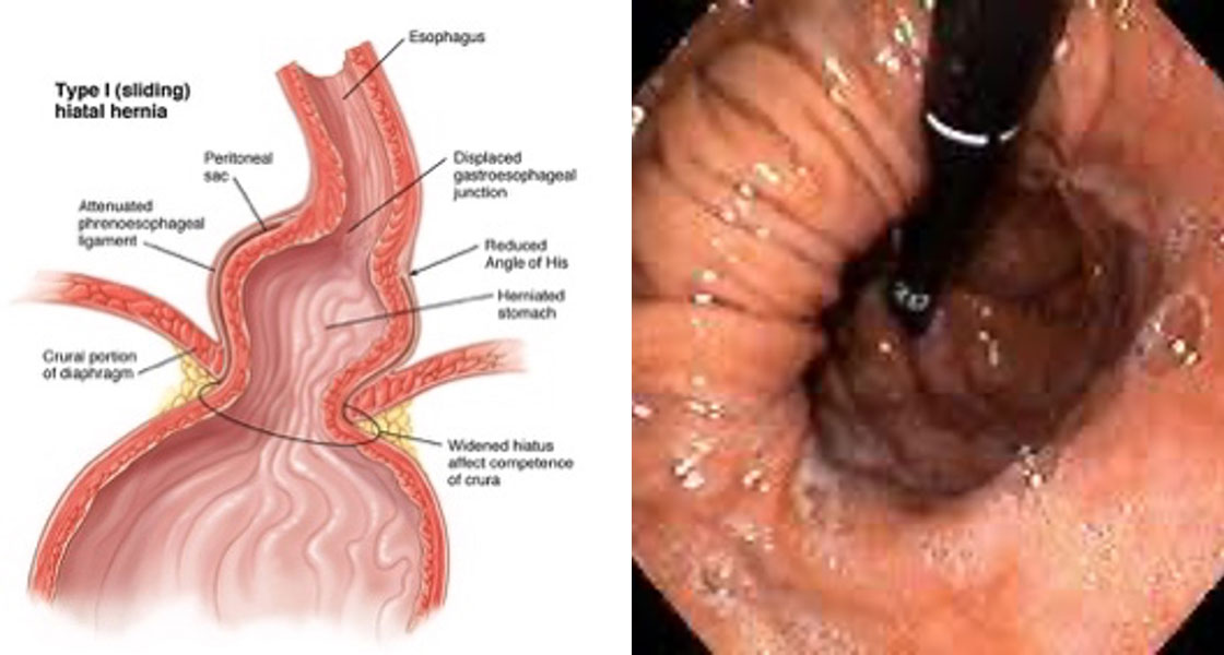 Tip 1 Mide Fıtığı