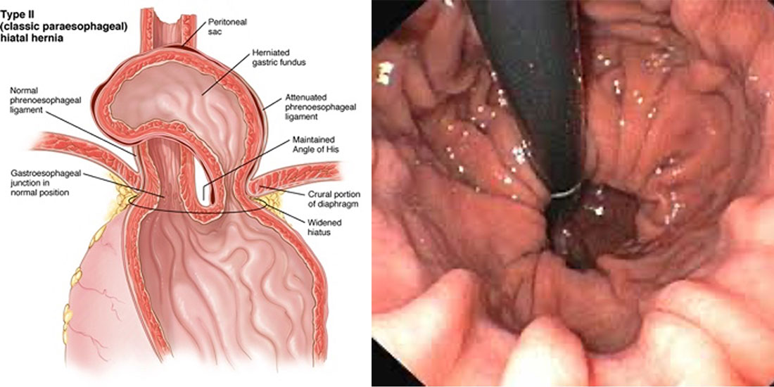 Tip 2 Mide Fıtığı