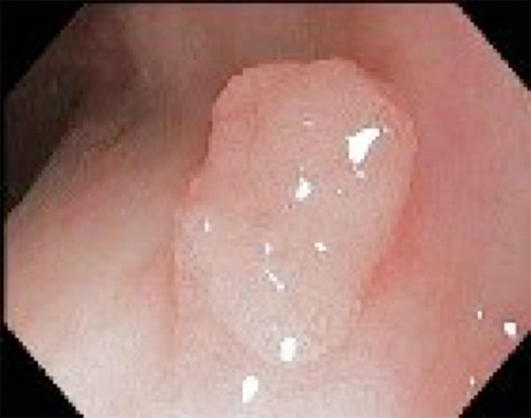 Yüksek Çözünürlük ve NBI?