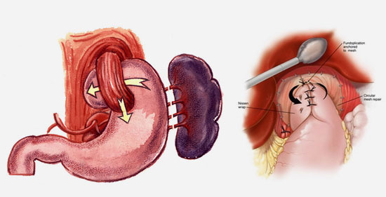 Nissen Ameliyatı: Reflü İçin Kalıcı Çözüm